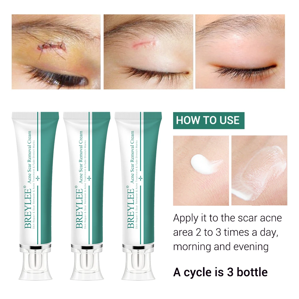 Removal Scar Cream Face Pimples Scar Stretch Marks Removal Acne Treatment Whitening Moisturizing Cream Skin Care