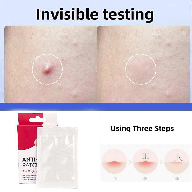 Hydrocolloid Acne Patch Invisible Makeup Closed Paste Net Acne Waterproof Breathable Acne Muscle Repair
