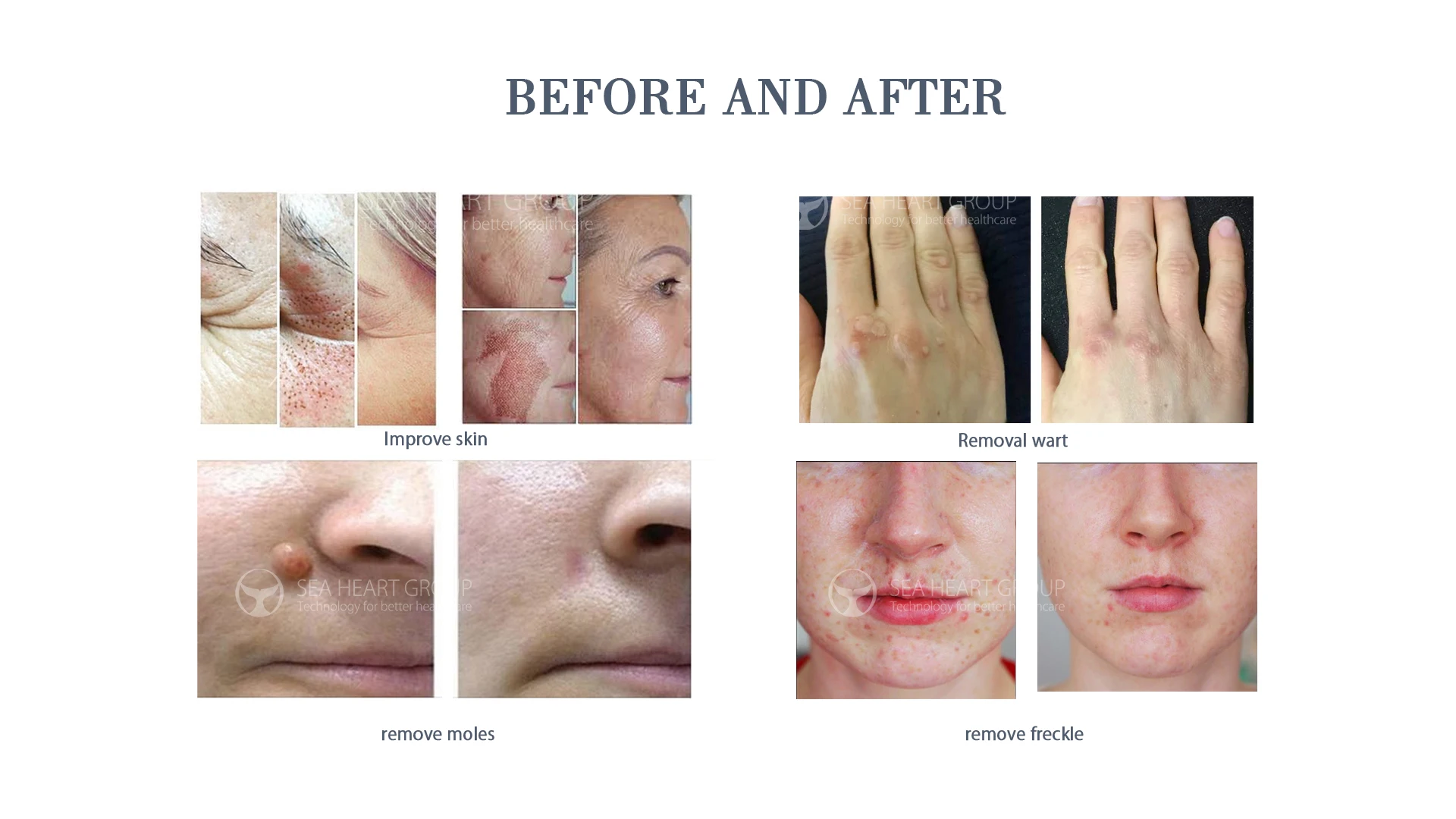 2020 new design 2 in 1  Face Lifting Plasma Pen  for Skin Tag Removal