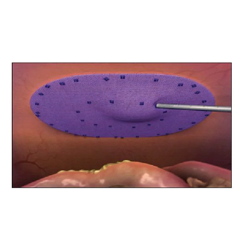 
Disposable Surgery Instruments Hernia Repair Mesh Fixation Device Absorbable Tacker 