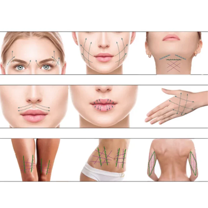 
Absorable sutureace face lifting double mesh 19g pdo thread 