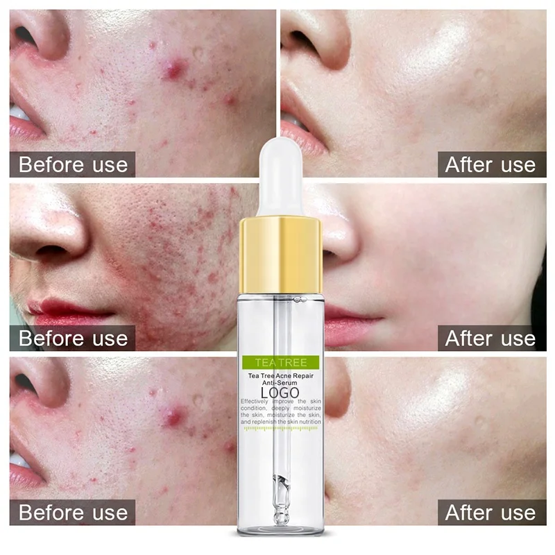 Low Price Sales Private Label Organic  Anti Acne Oil Control Acne Pimple Remover Face Serum Tea Tree Acne Repair Anti Serum
