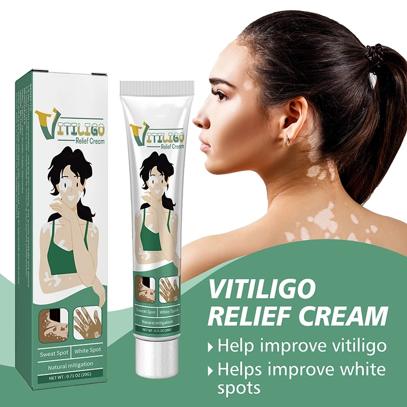 Vitiligo Cream Get rid of ringworm White spots Get rid of skin vitiligo Eliminate vitiligo