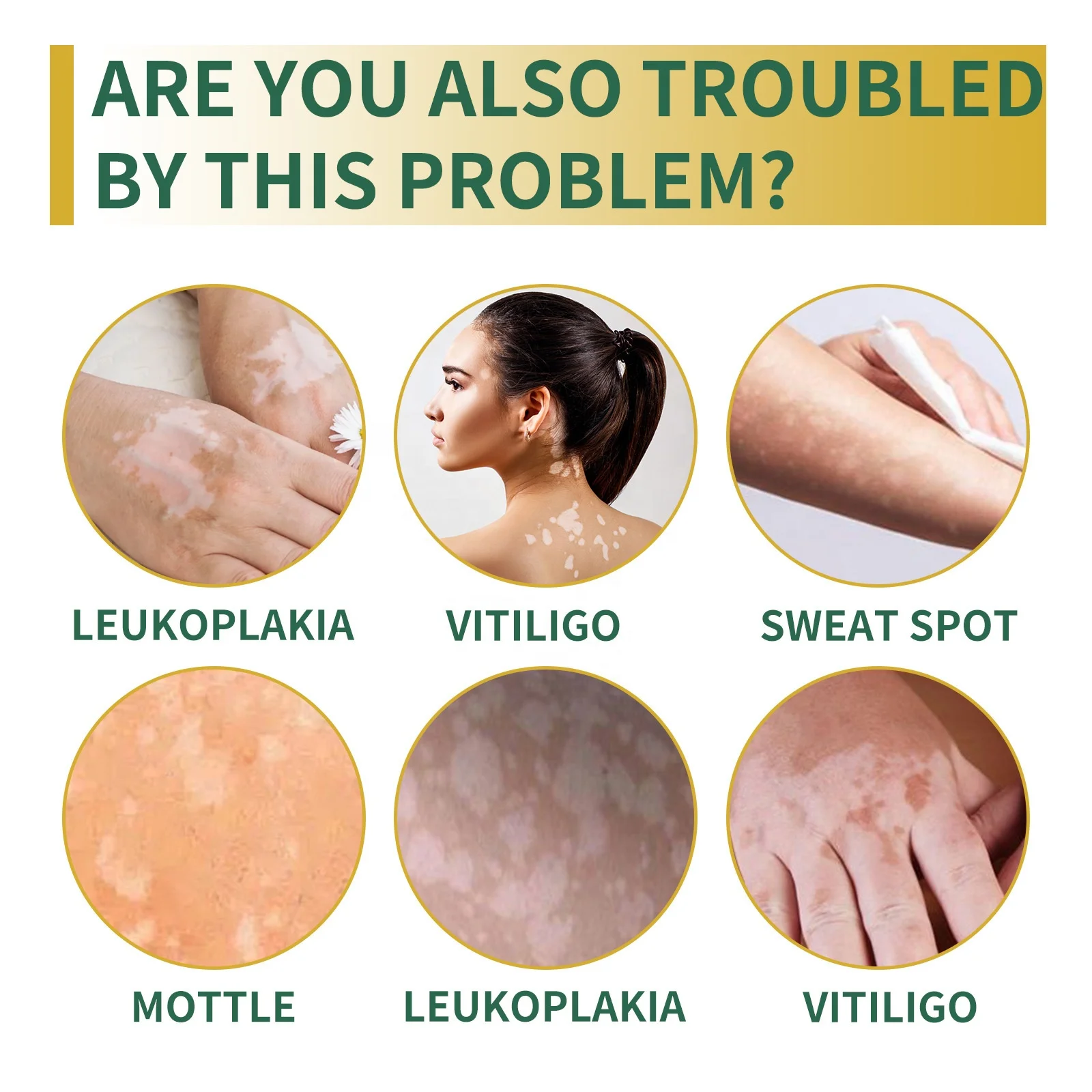 hot sale vitiligo cream white spot and vitiligo treatment skin care topical cream