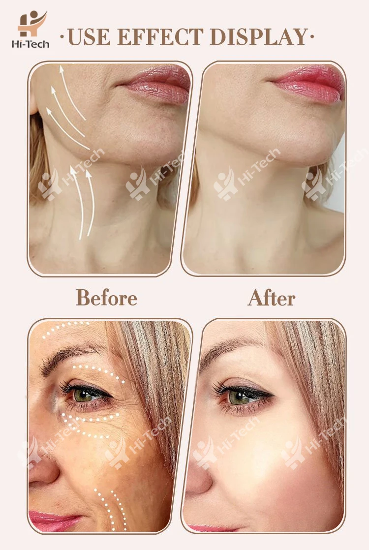 PDO Ultra V-lift Thread Improve Aging Skin With Non-surgical Thread Lift