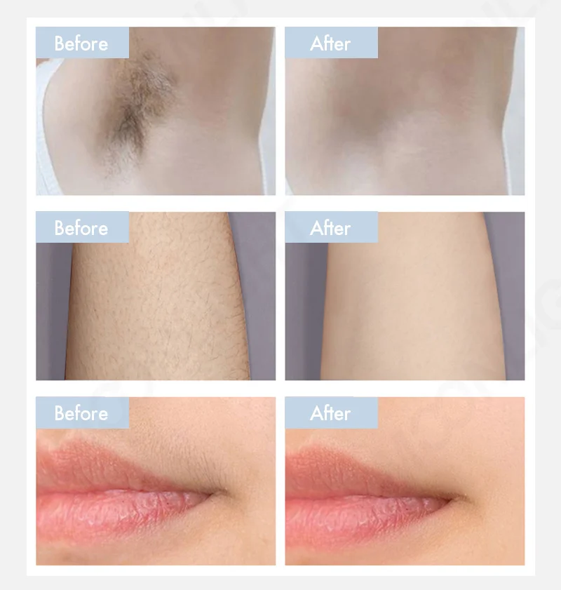 beijing 2023 laser super laser 808nm fiber coupled 1.5 um diode laser machine 1800w diode ice x