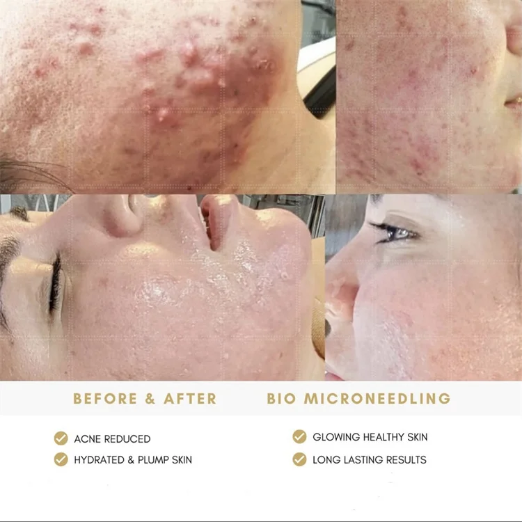 Skin Rejuvenation Hyperpigmentation and Melasma Sun Damage Treatment Bio Algae Peel Algae Spongila Spicule Acne Pigment Remove