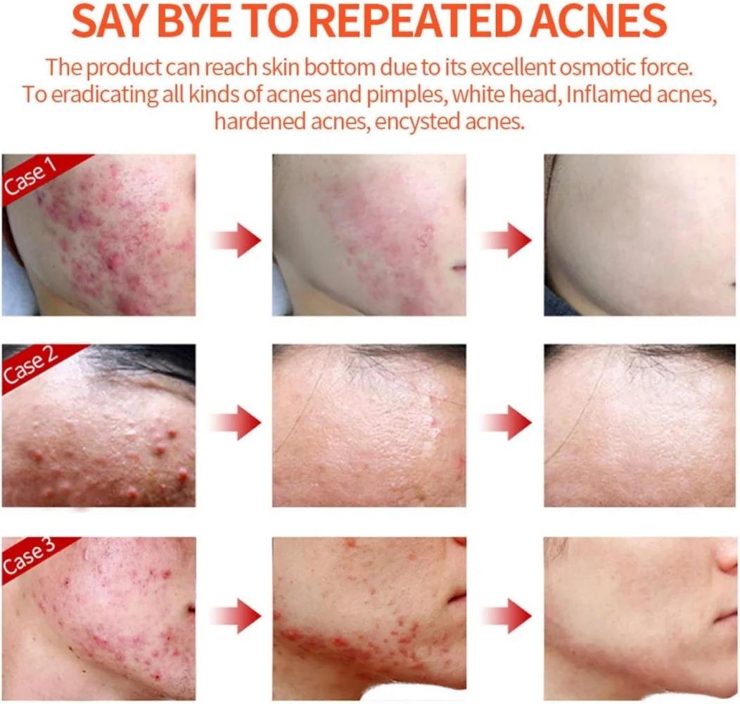 Private Label Acne Face Cream Anti Acne Refreshing Skin Oil Control Hydrating Fade Scars Reduce Acne Redness Face Cream