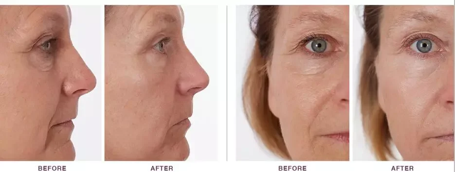 Korean Ampoule Dermal Filler Needle Free Injector Gun Lip Inject Acid Cross Linked Hyaluronic Acid Pen