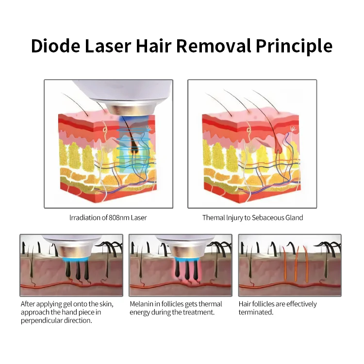 808nm Nd Yag Ice Titanium Diode Trio Laser 3 Waves Lazer Hair Removal 808nm Picosecond Tattoo Removal Machine