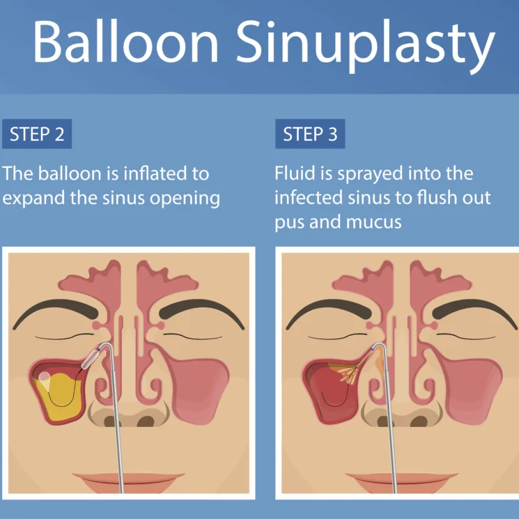 Coronado Brand ISO Approved Disposable Medical Balloon Sinuplasty System Manufacturer