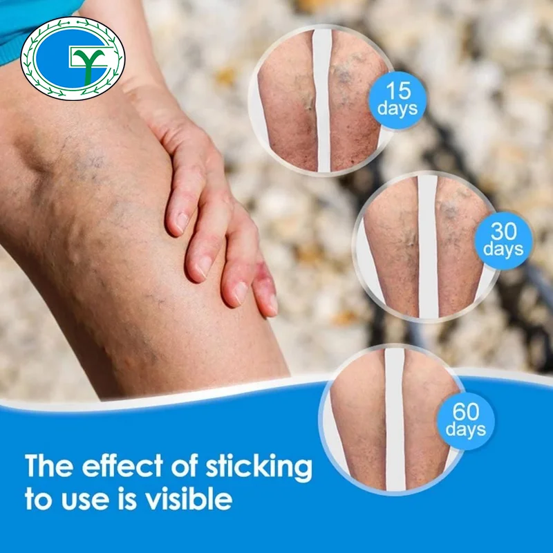 Sumifun 8pcs/bag Chinese Varicose Veins Plaster Vasculitis Phlebitis Spider Leg Medical Patch Angiitis Removal Patch