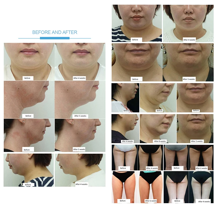 The Newly Upgraded  Radio Frequency Skin Tightening Fat Freezing Machine Slimming Shaping  Weight Loss Ultrasound Cavitation