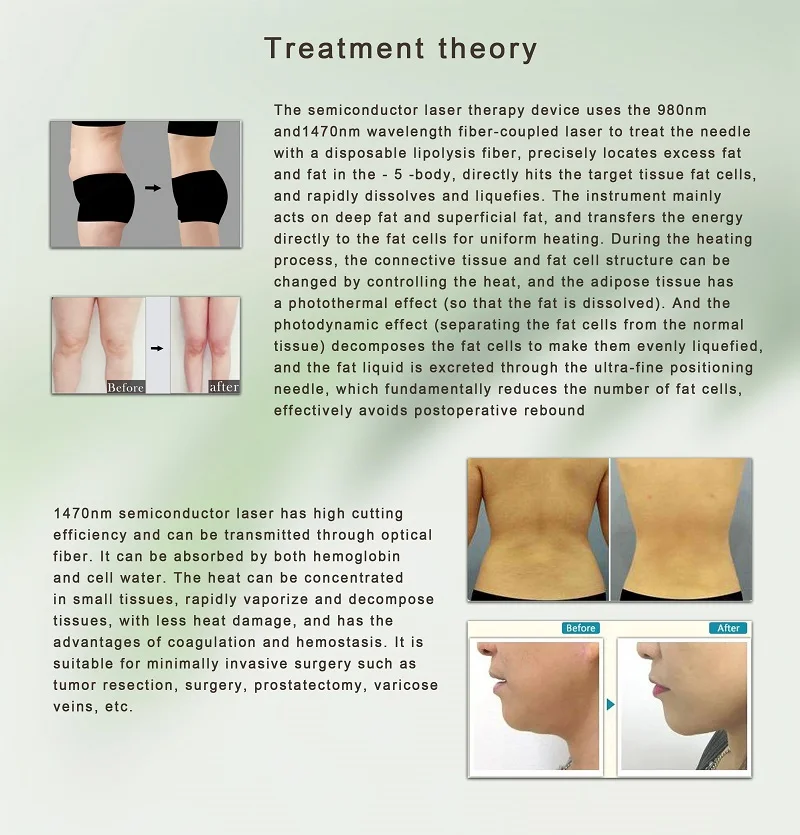 Best Quality Endolaser Diodo 980 Nm 1470 liposuction Diode Laser 980 1470 Nm For lipolysis 1470 Diode Laser fat reduction