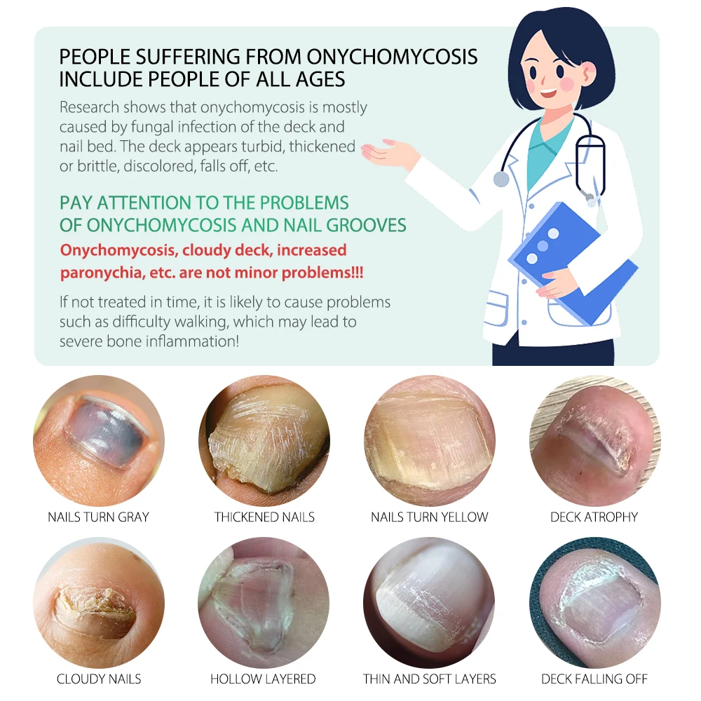 30ml MOOYAM 7 Days Fingernails Toenails Fungus Treatment Serum Repairs Damage and Treat Fungal Bacterial Infections Nail Serum