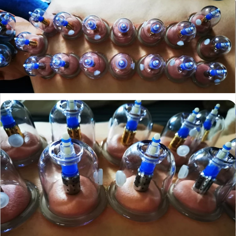 magnetic cupping9.jpg