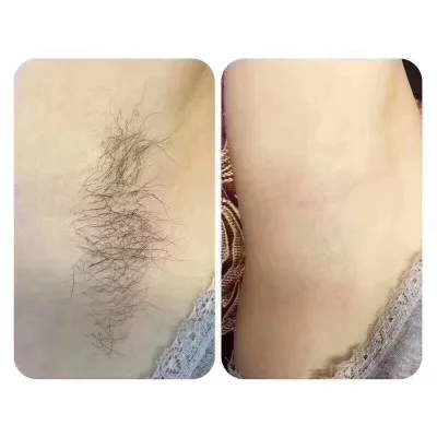 Diode Laser Hair Removal Machine 808nm Tri Wavelength  Spare Parts Handle Diode Ice Stationary Xl 24V