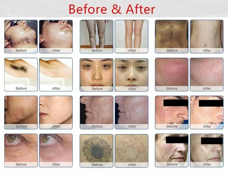 Fast Hair Removal Skin Rejuvenation Painless RF E-light Epilator Instrument Device IPL Laser Hair Removal