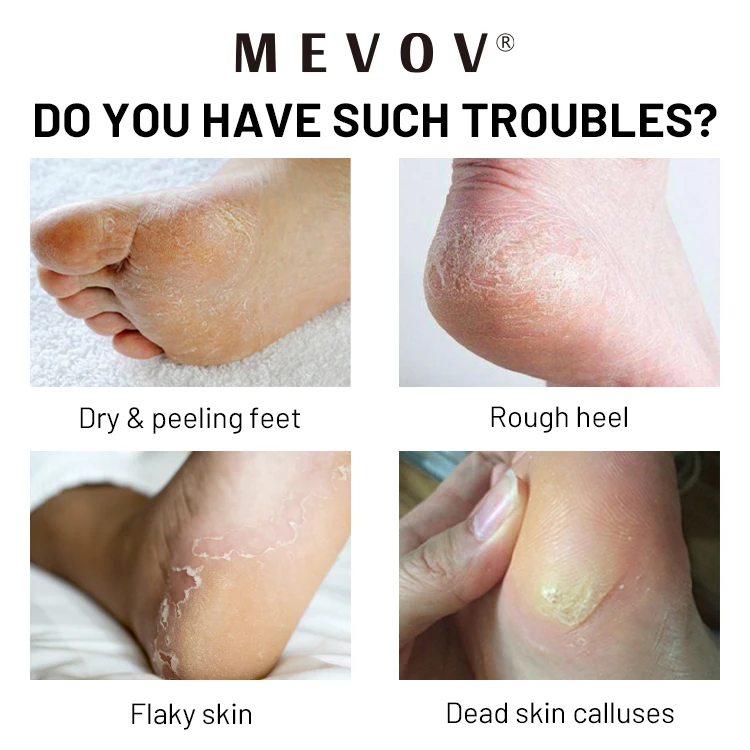 Private Label Moisturizing Hydrates Protect Foot Licorice Root Cracked Feet Cream