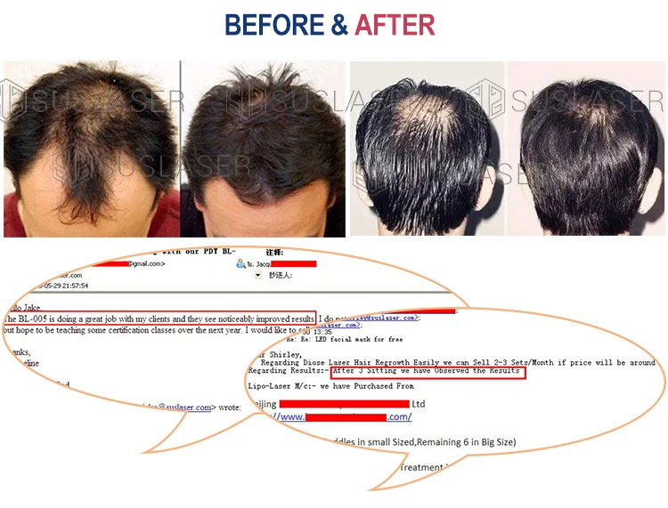 650nm Diode laser hair growth machine hair regrowth laser Beauty Equipment