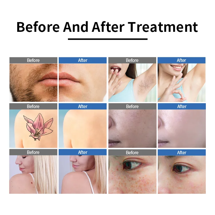 808nm Nd Yag Ice Titanium Diode Trio Laser 3 Waves Lazer Hair Removal 808nm Picosecond Tattoo Removal Machine