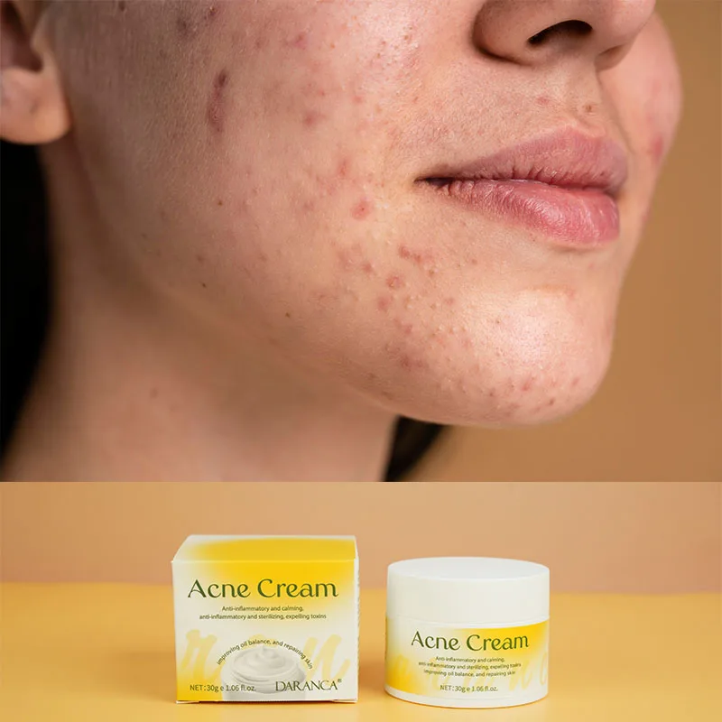 Dark Skin Acne Scar Spot removal Treatment Repair Cream For Acne Prone Sensitive Skin Fade Face