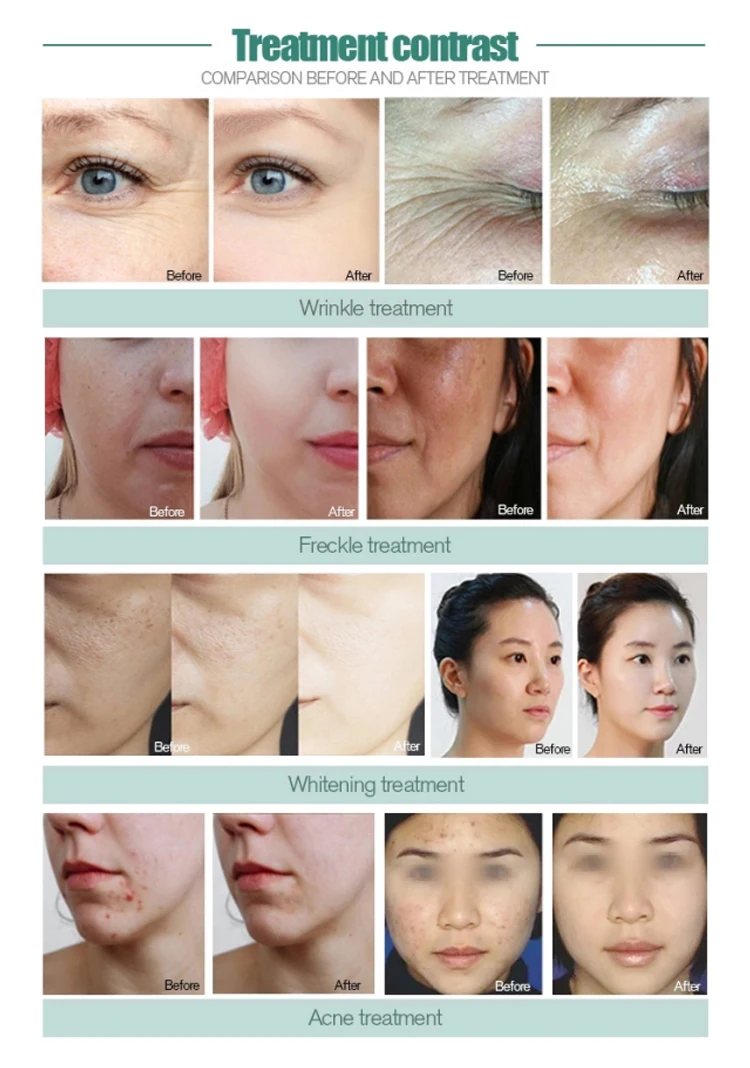 CE ISO Oxygen Water Peeling Beauty Dermabrasion Price Facials Oxygen Jet Oxygen Facial Machine Facial Machine