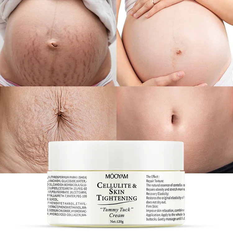 OEM ODM Wholesale Skin Repair Anti Stretch Marks Cream Popular Body Pregnancy Scars Stretch Marks Removal Cream