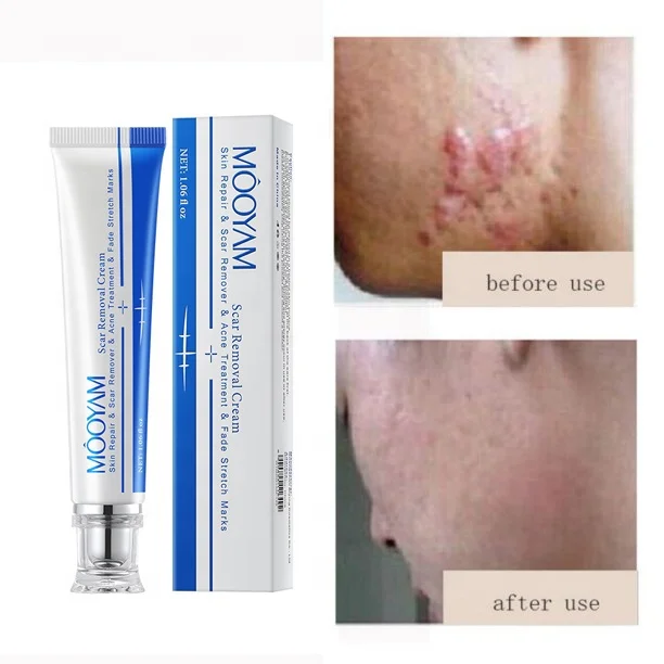 Private Label Free Sample Face Skin Stretch Marks Relief Burns Repair Cream Scar Removal Cream Scar Cream For Old Scars