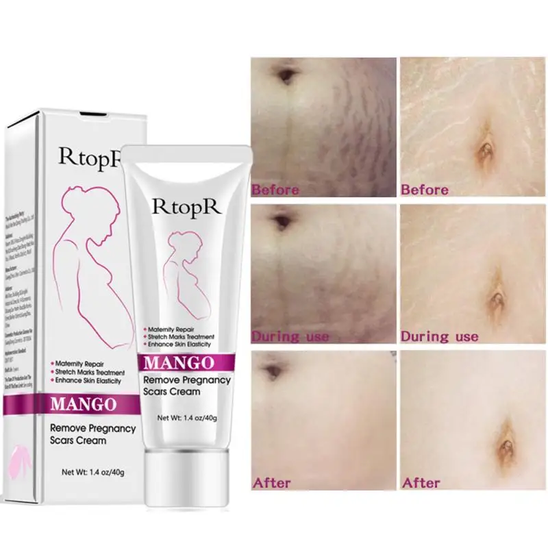 Private Label Best Rtopr 100% Natural Snail  Mango Anti Removal Stretch Mark Cream