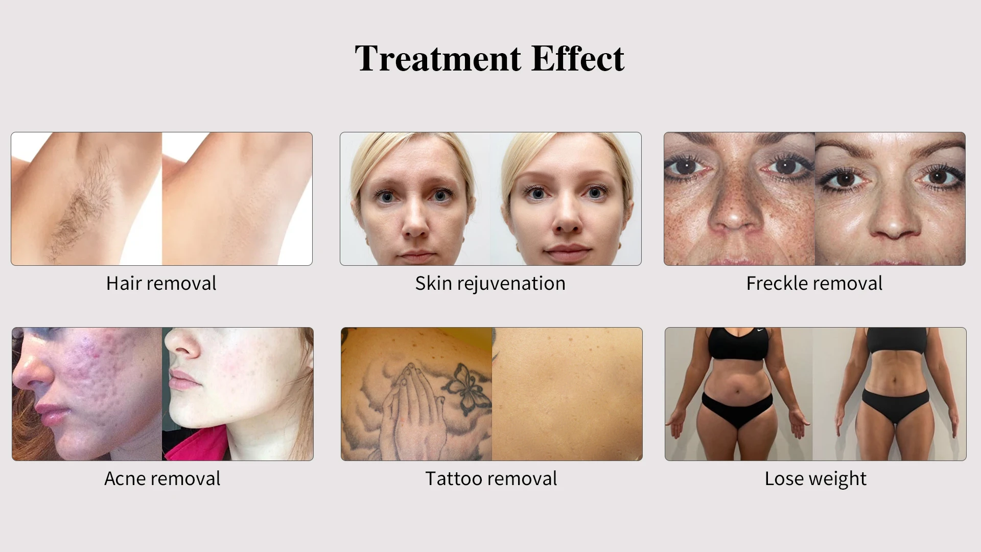 2024 New arrivals laser beauty equipment ice laser hair removal machine 808 755 1064 3 wave diode laser hair removal 4in1