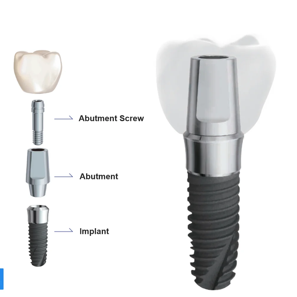 Dental Implant Fixture And Screw And Abutment Implants & Interventional Materials