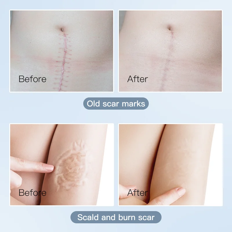 High Quality Roll Shape 4cmx1.5M silicone scar sheets New products Factory Price Silicone Gel Scar Away Sheets for Scars removal