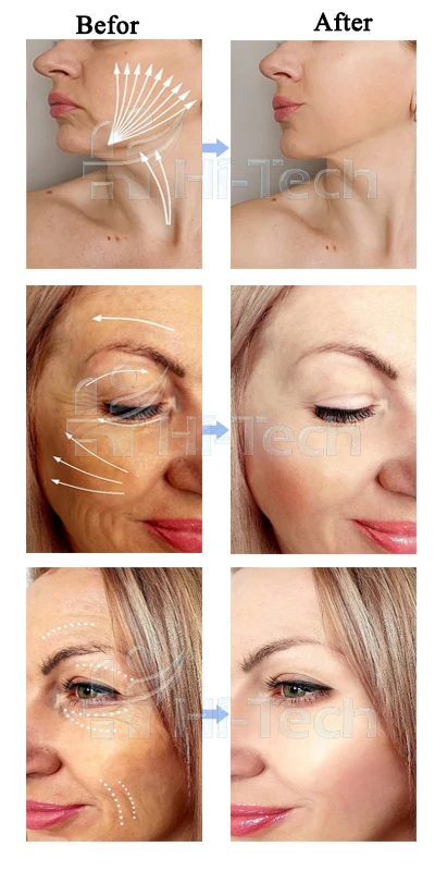 PDO Screw Thread Lift 30G 50mm With Sharp Needle For Anti-wrinkle