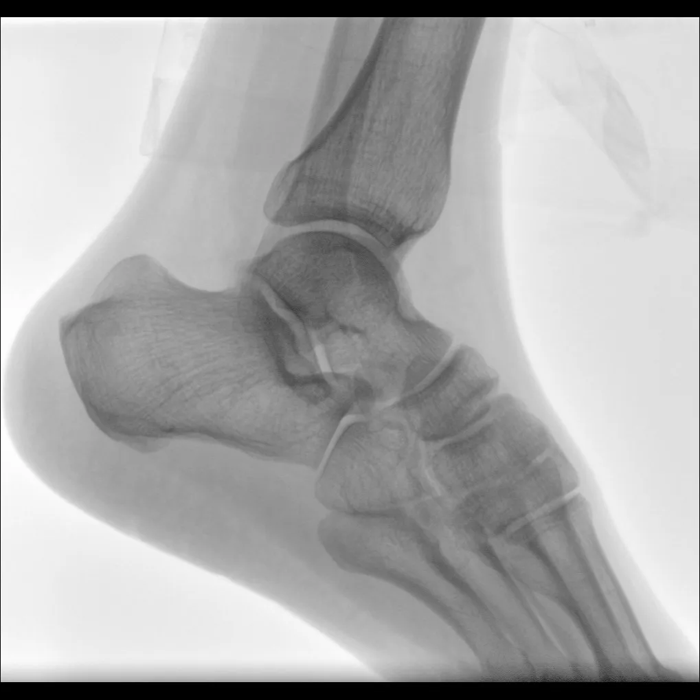 X-ray C-arm machine PLX118F what is c arm x ray machine