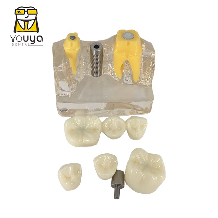 Dental Implant 4 Times Removable Teeth Model For Dental Clinic