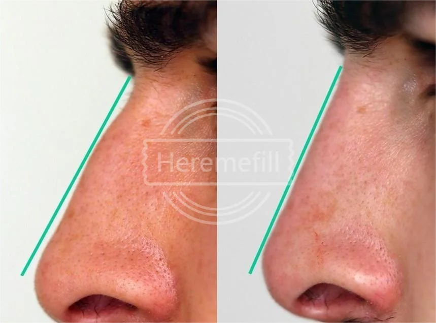 Heremefill Cross-Linked Hyaluronic Acid Dermal Filler Body Nose Face Lip Enhancement Fillers
