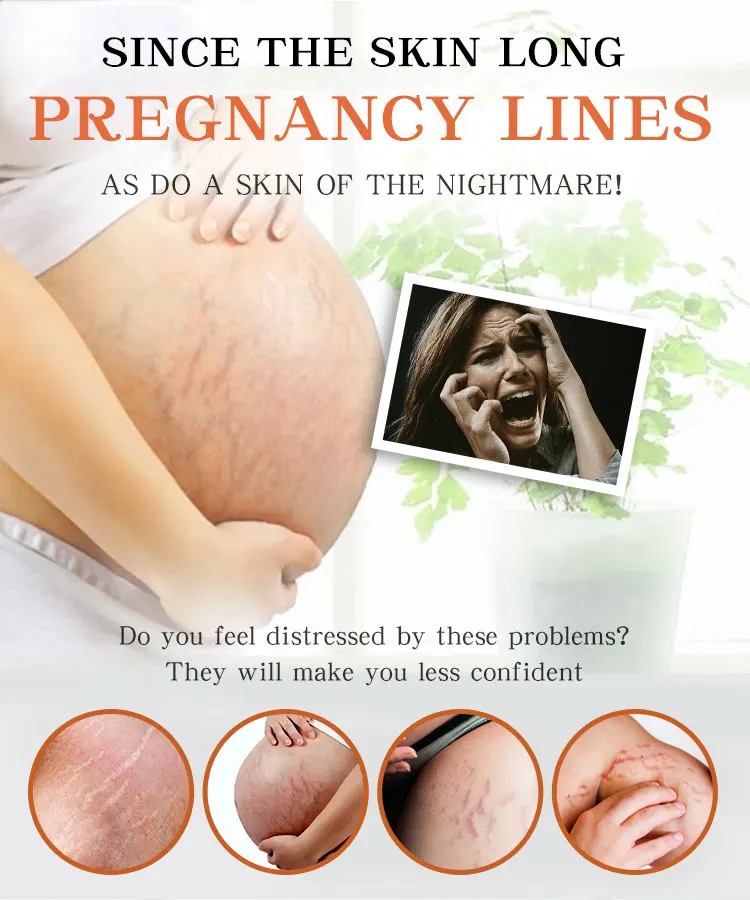 
New arrival stretch marks removal cream and tighten skin repair OEM 