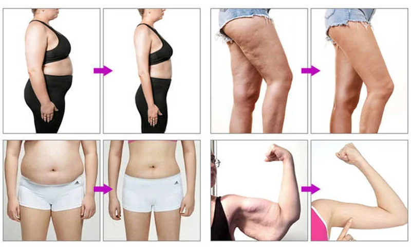 A new portable liposonixed skin stretch slim body shaping device At home intelligent liposonixed slimming ultrashape device