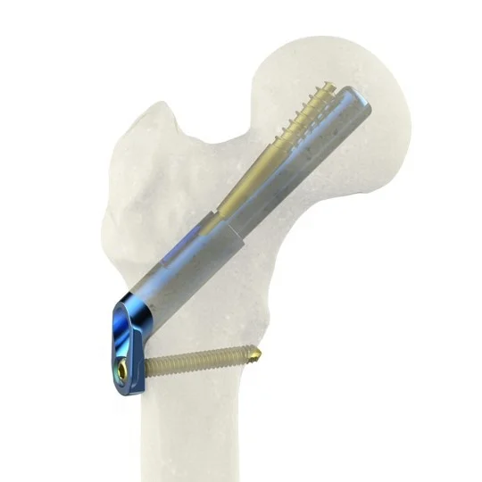 Проксимальная бедренная бедра титановая фиксирующая пластина ортопедика минимальные инвазивные бедренные двойные медицинские титановые имплантаты