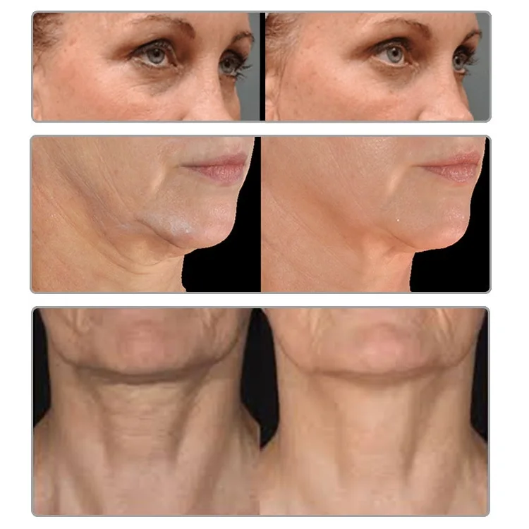 Remodel collagen gold rf crystallite for eyebrow lifting jalw tightening fractional rf acne treatment beauty machine