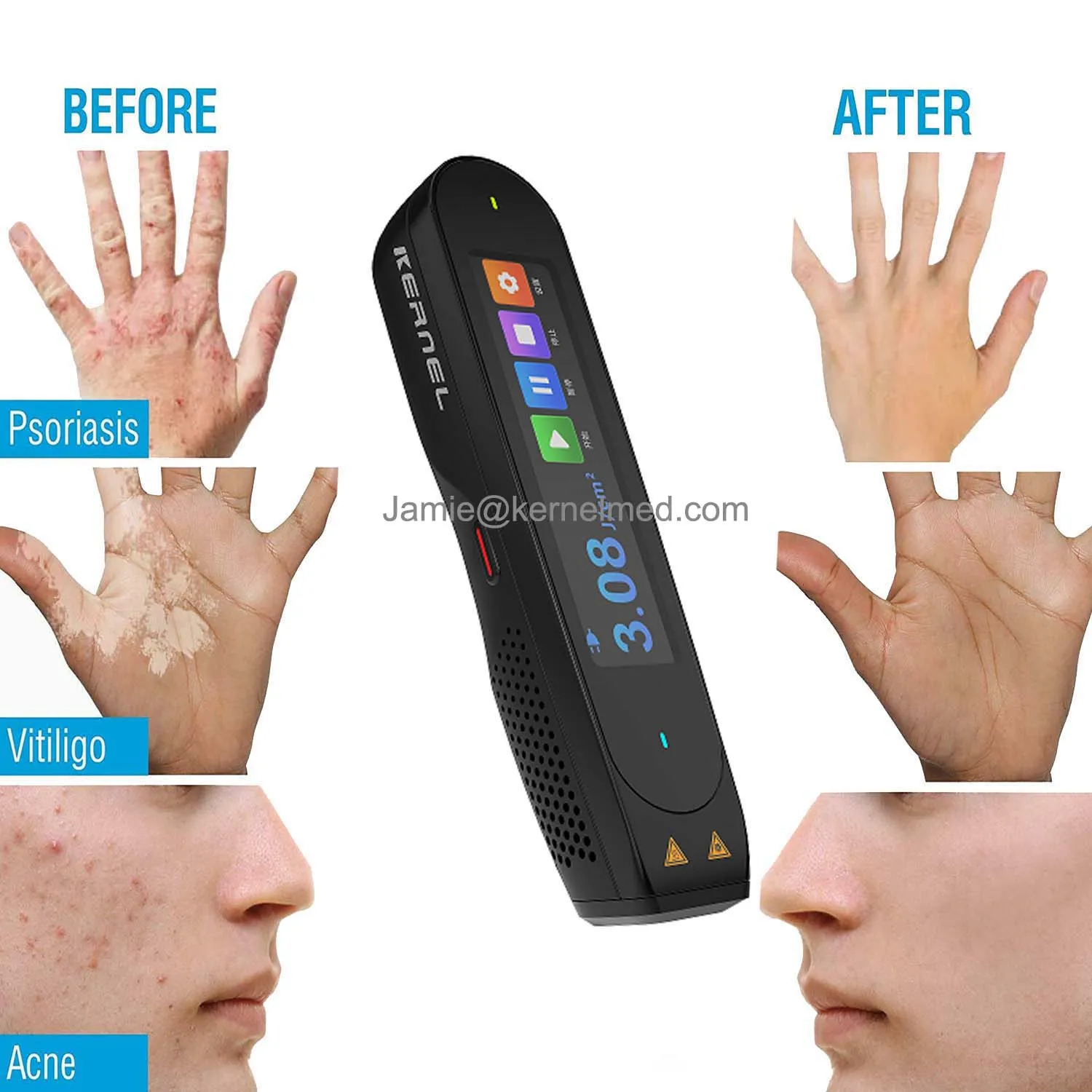 LED UV Light Therapy Excimer Laser 308nm UVB Phototherapy 308 nm Xenon Chloride Excimer For Psoriasis Vitiligo Treatment