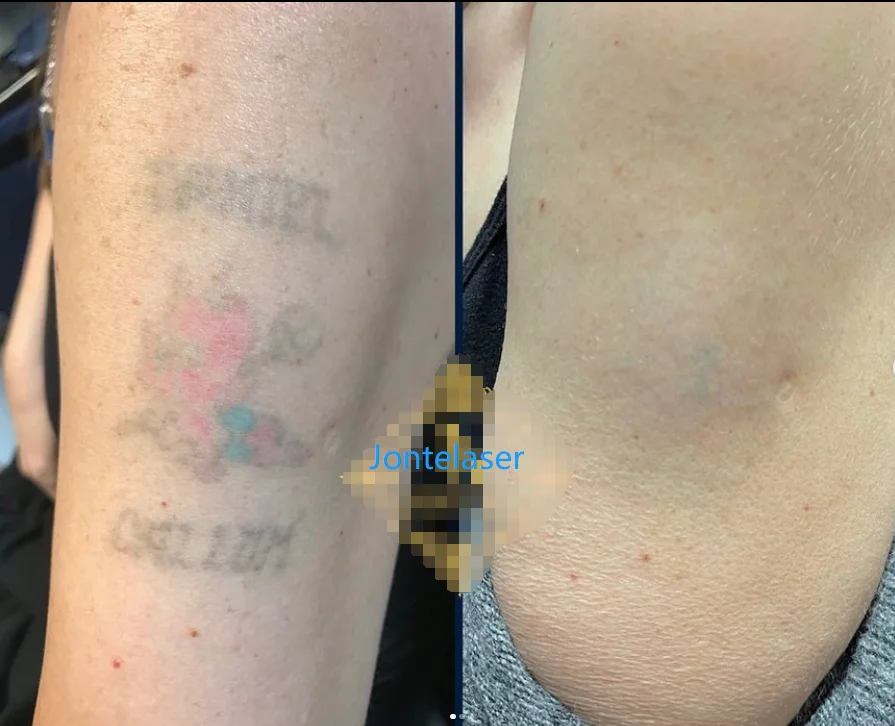 Picosur Laser ND Yag Tatoo Remove Laser Picosecond Pigmentation Removal Machine
