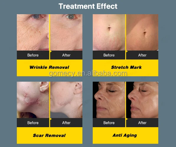 2024  CE Microneedle Fraction R Microneedle Fractional Machine/Micro Needle Fractional R Face Lifting Machine