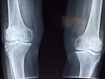 
Joint Pain Relief Herbal & Health Supplement wt Glucosamine, Chondroitin & MSM. Best OEM Natural Supplement For Arthritis. 