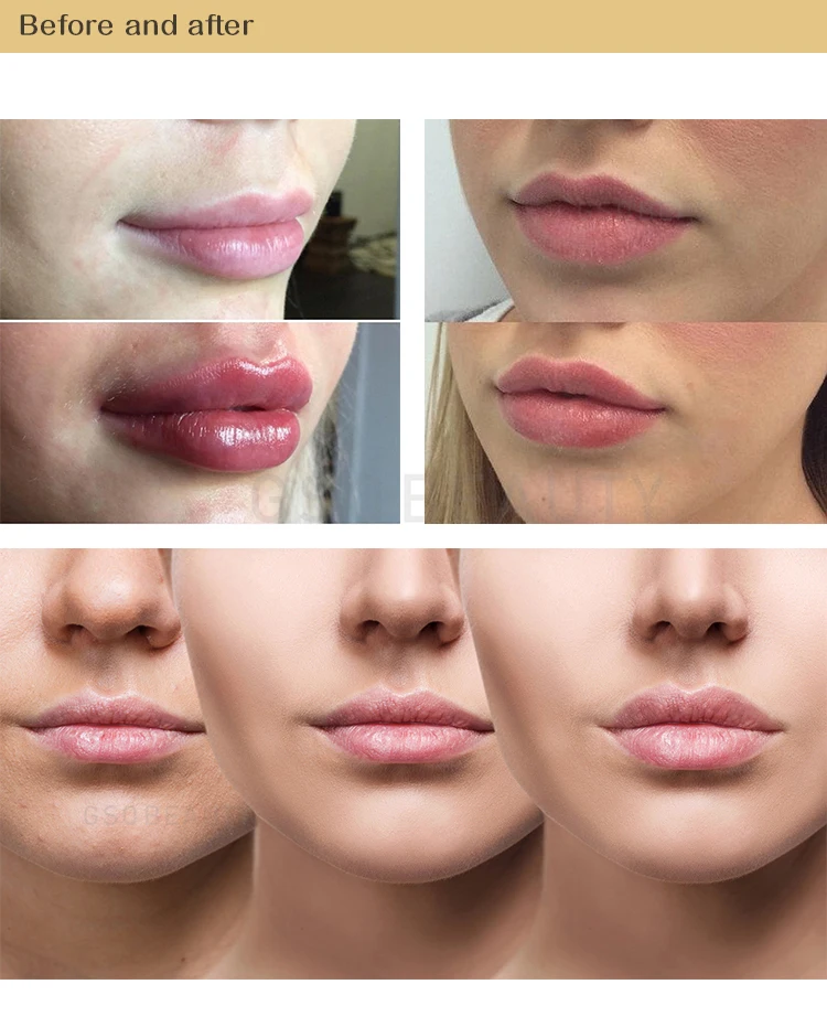 High Pressure Gun Needle Free Meso gun0.5  hyaluronic acid injection pen  lip lifting hyaluronic filler pen