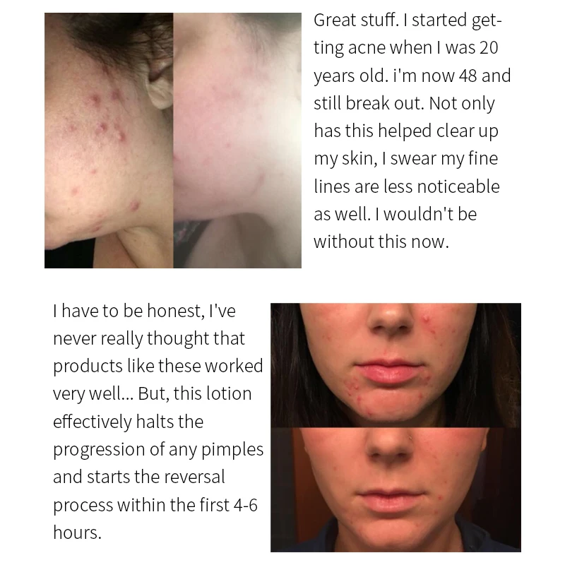 OEM Drying Lotion Acne Pimple Surface Blemish Removing Serum Dark Spot Remover Calamine Lotion