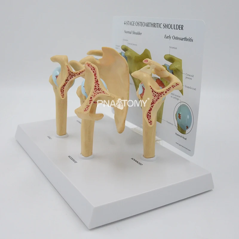 4-STAGE OSTEOARTHRITIS (OA) SHOULDER ANATOMY MODEL HUMAN SKELETON ANATOMICAL MODEL TEACHING RESOURCES EDUCATIONAL EQUIPMENT