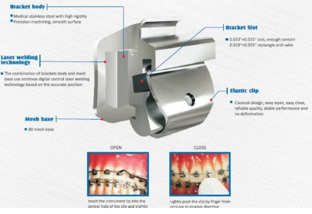 Dental orthodontics fixed teeth with high quality metal brackets/Dental orthodontic materials high-grade  metal brackets