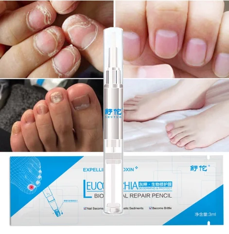 Nail Fungus Repair Treatment Pen Products Onychomycosis Paronychia Anti Fungal Nail Infection Chinese Herbal Care Oil Pen
